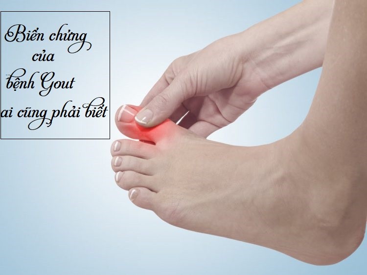 Các biến chứng của bệnh Gout ai cũng phải biết