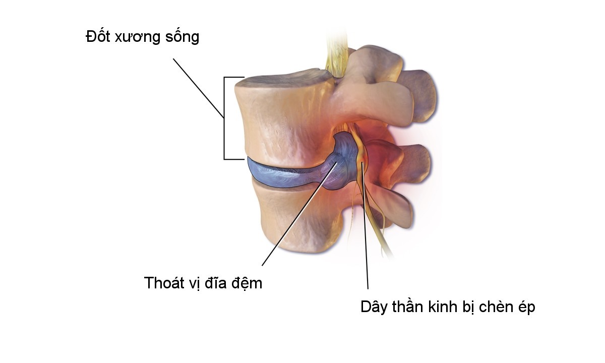 Phồng đĩa đệm có nguy hiểm không? Có chữa được không?