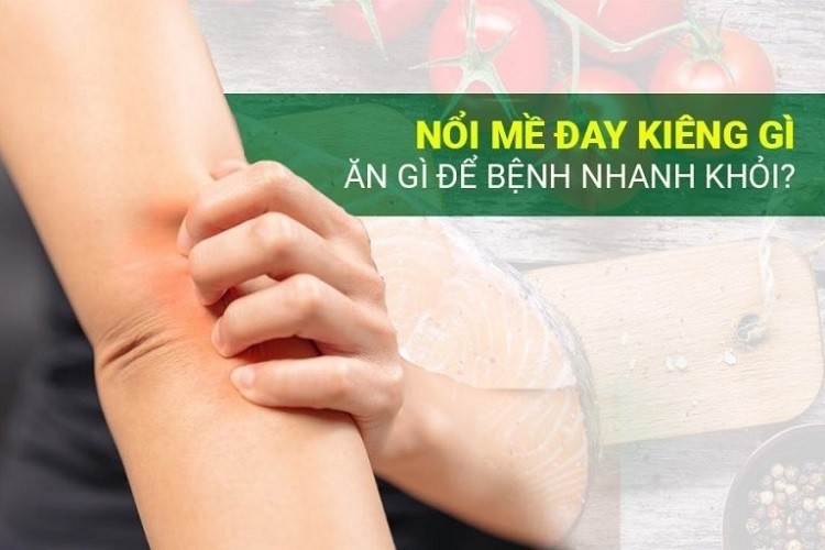 Bị nổi mề đay kiêng gì? Cách trị nổi mề đay