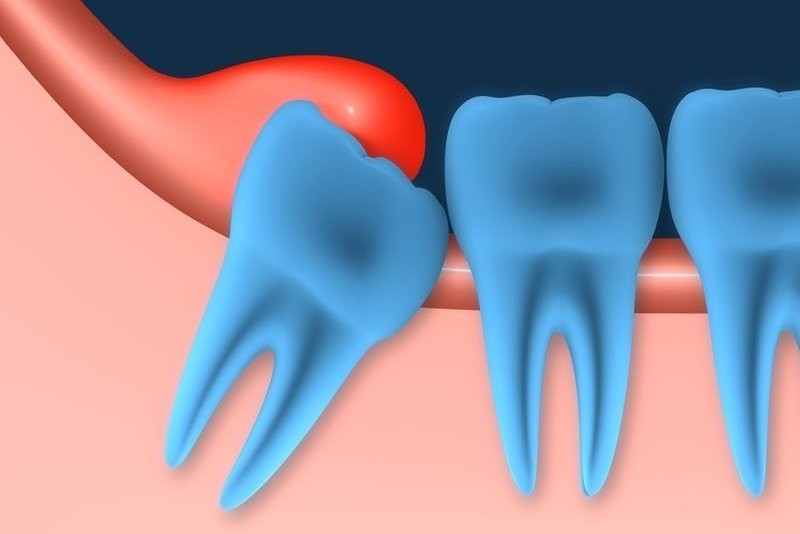 Tổng hợp 5 cách chữa viêm lợi trùm tại nhà