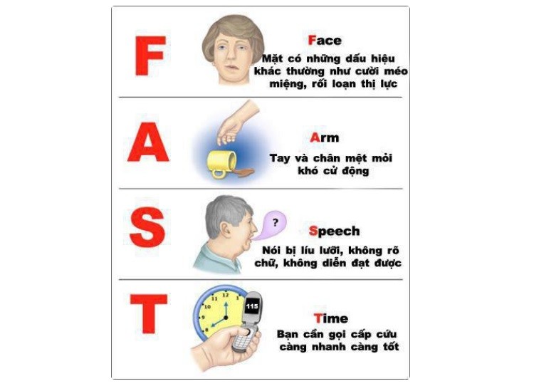 dấu hiệu đột quỵ FAST