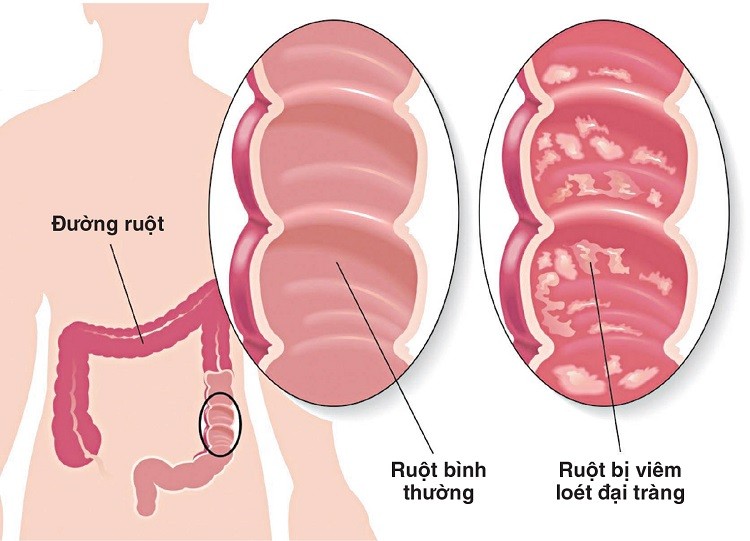 Bệnh Crohn