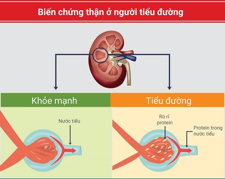 bệnh tiểu đường