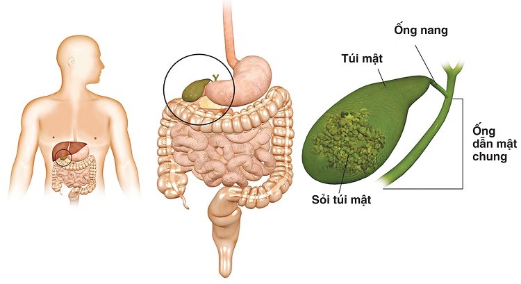 Ngăn ngừa sỏi thận, sỏi mật