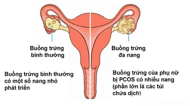 Do hội chứng bồi trứng đa nang