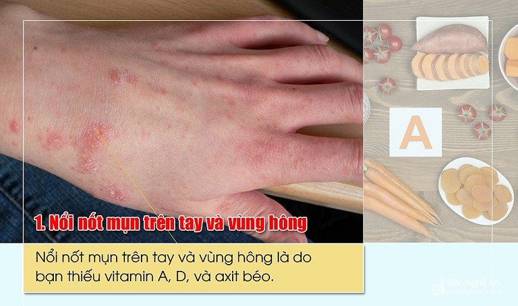 dấu hiệu cơ thể thiếu vitamin A