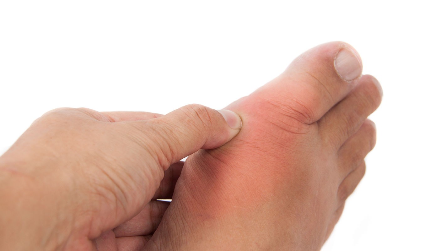 Gout hay Gút là hội chứng rối loạn chuyển hóa các chất
