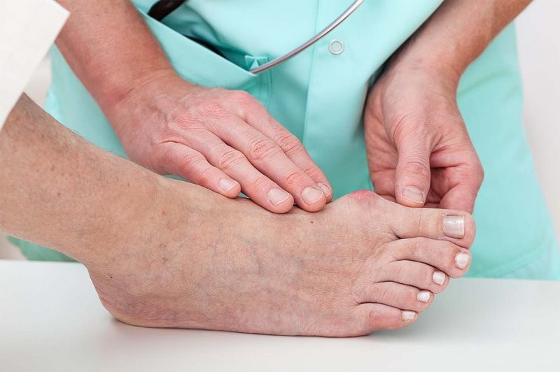 Gout là triệu chứng của rối loạn chuyển hóa acid uric trong máu