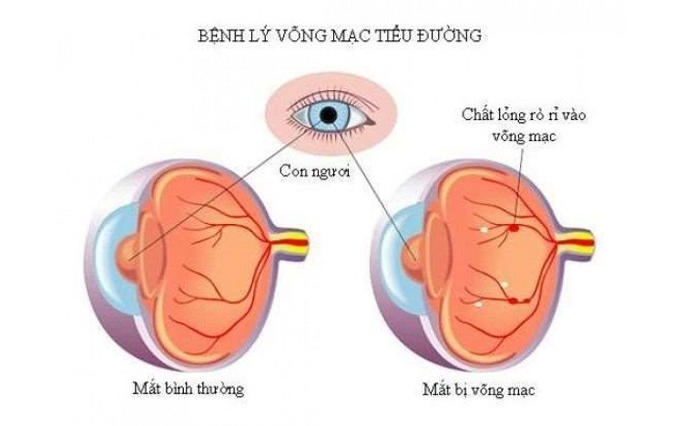 Tiểu đường biến chứng ở mắt