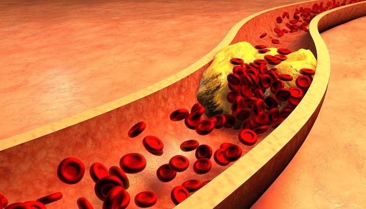 Bệnh mỡ máu gây ra lắng đọng cholesterol
