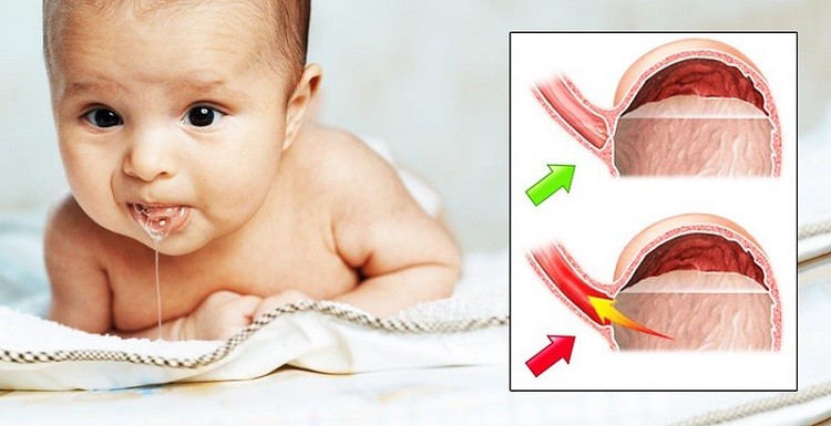 trào ngược dạ dày ở trẻ