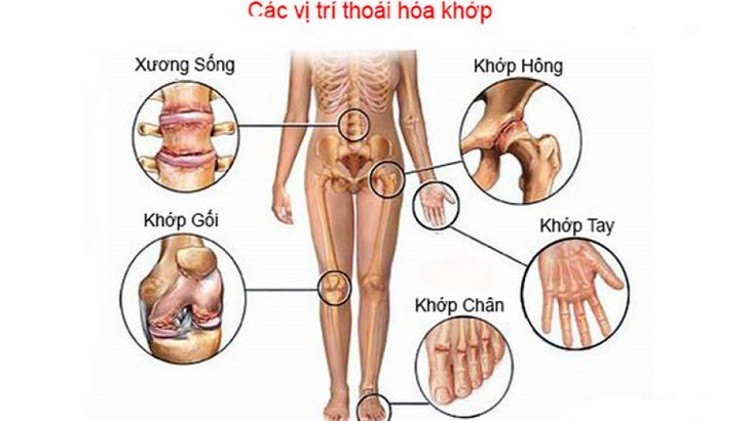 Các vị trí thường bị thoái hóa khớp