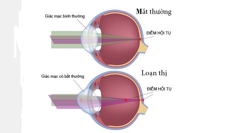 Loạn thị