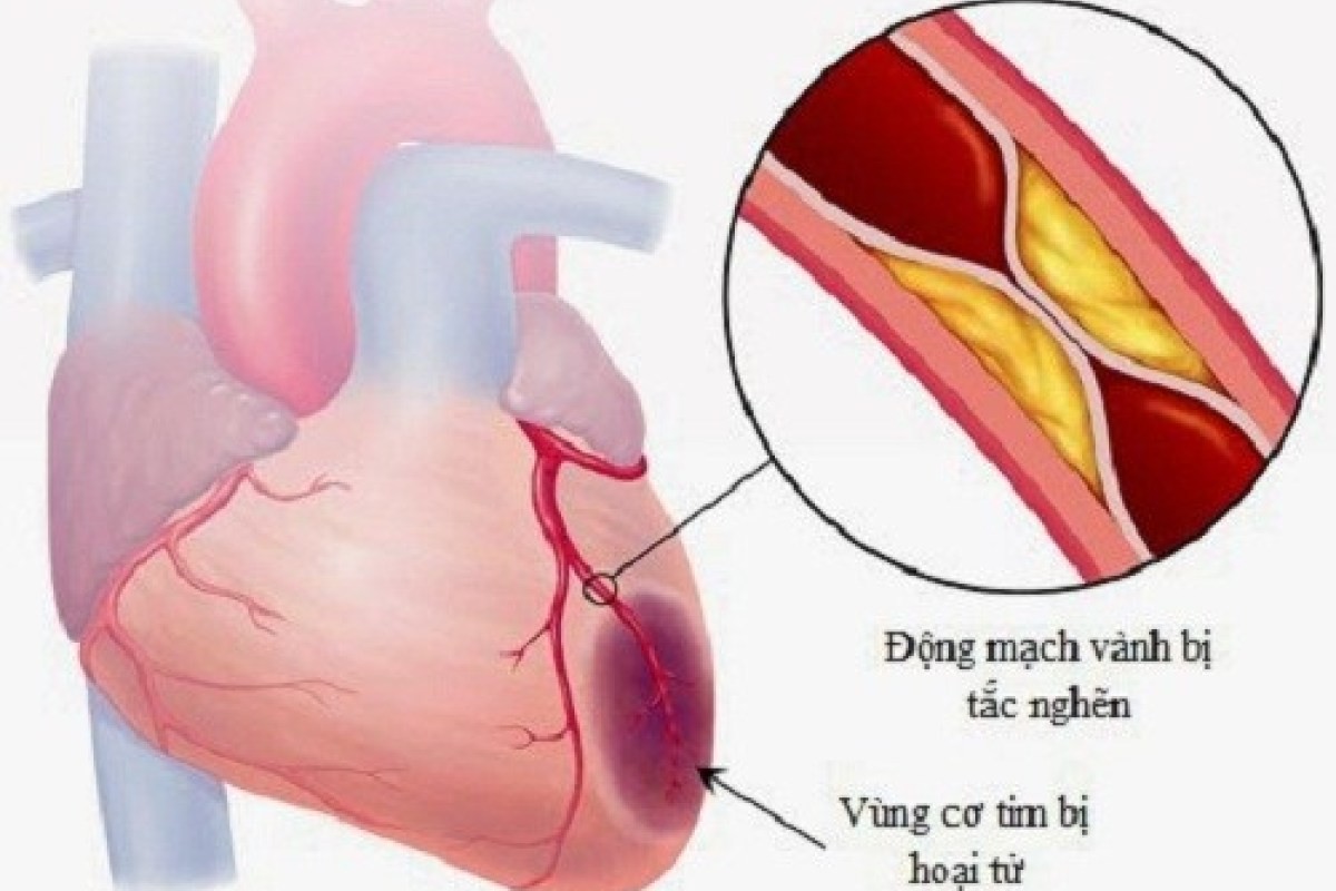 Nhồi máu cơ tim