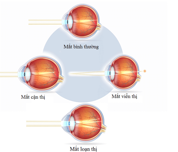 Các tật khúc xạ mắt