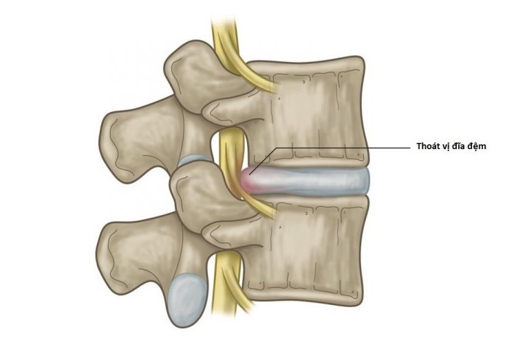 thoát vị đĩa đệm là gì, triệu chứng thoát vị đĩa đệm cổ, thoát vị đĩa đệm cổ là gì, thoát vị đĩa đệm lưng là gì, bị thoát vị đĩa đệm là gì, các triệu chứng thoát vị đĩa đệm, triệu chứng của thoát vị đĩa đệm là gì, triệu chứng thoát vị đĩa đệm mông, nguyên nhân triệu chứng bệnh thoát vị đĩa đệm, bệnh thoát vị đĩa đệm là gì, chữa thoát vị đĩa đệm là gì, giá thoát vị đĩa đệm là gì, triệu chứng thoát vị đĩa đệm, triệu chứng thoát vị đĩa đệm net, triệu chứng thoát vị đĩa đệm lưng, triệu chứng thoát vị đĩa đệm nhẹ, triệu chứng thoát vị đĩa đệm đốt sống lưng, hội chứng thoát vị đĩa đệm, nguyên nhân triệu chứng thoát vị đĩa đệm, nguyên nhân và triệu chứng thoát vị đĩa đệm, chịu chứng thoát vị đĩa đệm, biến chứng thoát vị đĩa đệm