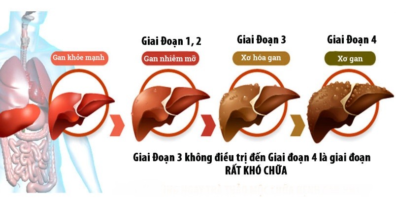 gan nhiễm mỡ độ 2 là gì, gan nhiễm mỡ nhẹ là gì, bệnh gan nhiễm mỡ là gì, gan nhiễm mỡ s3 là gì, gan nhiễm mỡ s1 là gì, gan nhiễm mỡ là bị gì, thuốc gan nhiễm mỡ là gì, gan nhiễm mỡ độ 1 là gì, chỉ số gan nhiễm mỡ là gì, triệu chứng gan nhiễm mỡ là gì, bị gan nhiễm mỡ là gì