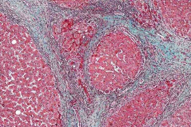 bệnh xơ gan là gì, xơ gan, bệnh xơ gan, triệu chứng xơ gan, bệnh xơ gan có chữa được không, bệnh xơ gan có lây không, điều trị xơ gan, dấu hiệu xơ gan