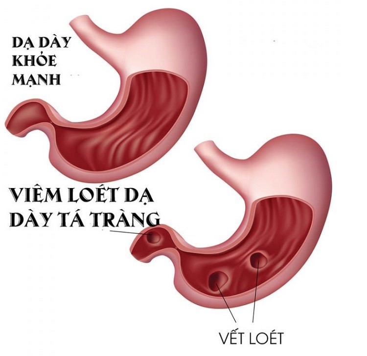Viêm loét dạ dày tá tràng