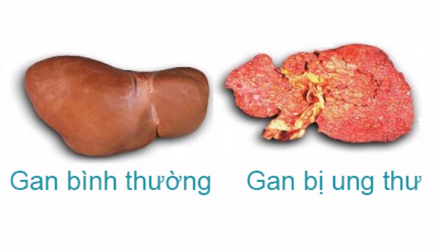 Nhu mô gan thô là gì? Những điều bạn cần biết về nhu mô gan thô nhu mô gan thô là bệnh gì, gan nhu mô thô là gì, nhu mô gan thô có phải là xơ gan, nhu mô gan là gì, gan thô là gì, gan thô là như thế nào, nhu mô gan thô là gì, bệnh lý chủ mô gan là gì, nhu mô gan thô nhẹ là gì, gan bị thô có chữa khỏi được không