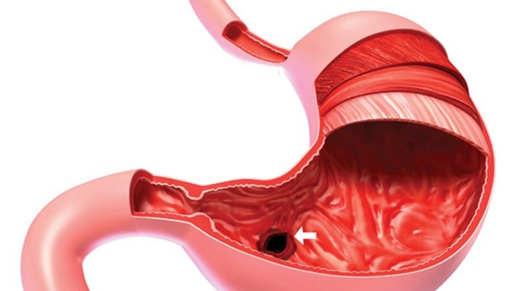 Viêm xung huyết niêm mạc hang vị dạ dày