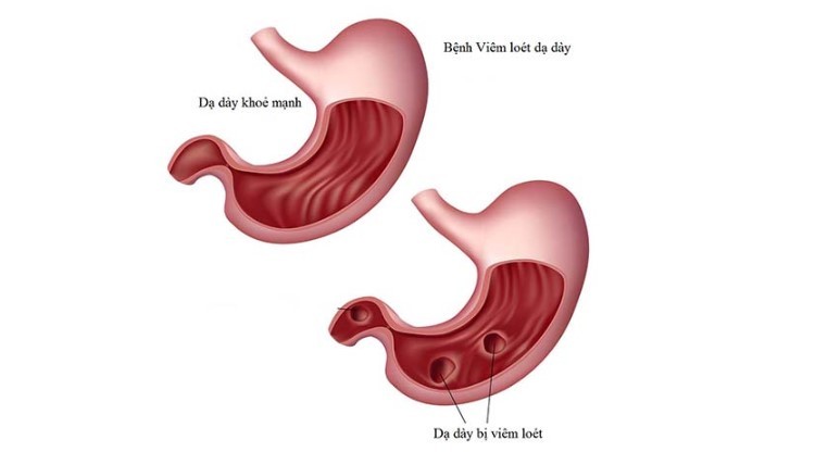 Vạch trần thông tin thuốc dạ dày Cụ Tòng lừa đảo Thuốc dạ dày Cụ Tòng, Thuốc dạ dày cụ tòng có tốt không, Thuốc chữa dạ dày đại tràng cụ tòng, Thuốc trị dạ dày cụ Tòng, Thuốc dạ dày đại tràng cụ Tòng, Thuốc chữa dạ dày cụ Tòng, Thuốc chữa dạ dày cụ Tòng có tốt không, Thuốc trị dạ dày đại tràng cụ tòng, thuốc chữa đau dạ dày cụ tòng, thuốc trị dạ dày cụ tòng, thuốc chữa dạ dày cụ tòng, thuốc dạ dày Cụ Tòng lừa đảo