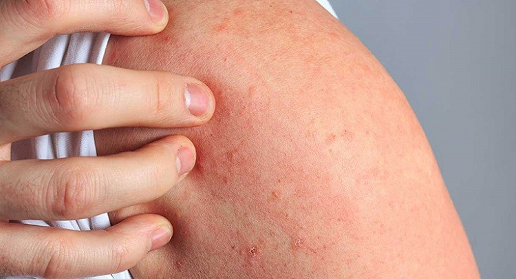 Bị nổi mề đay kiêng gì nổi mày đay kiêng gì, bị nổi mề đay kiêng gì, nổi mề đay nên kiêng gì, nổi mề đay kiêng những gì, nổi mề đay cần kiêng gì, dị ứng nổi mề đay kiêng gì, bị nổi mề đay phải kiêng gì, nổi mề đay có kiêng gì không, ngứa nổi mề đay kiêng gì, nổi mày đay nên ăn gì, bệnh nổi mề đay kiêng gì, nổi mề đay kiêng gì, nổi mề đay nên ăn gì, dị ứng thời tiết nổi mề đay kiêng gì, trẻ bị nổi mề đay kiêng gì, cách trị nổi mề đay kiêng gì