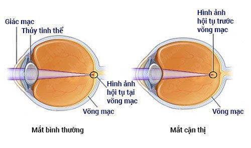 cận loạn thị là gì, độ cận thị là gì, tật cận thị là gì, đo cận thị ở đâu, cận thị là gì viễn thị là gì, nguyên nhân gây cận thị là gì, nhất cận thị nhị cận giang là gì, cận thị thoái hóa là gì, mắt cận thị là gì