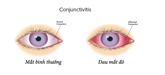 Đau mắt đỏ lây qua đường gì thuốc nhỏ mắt tốt cho người cận thị, thuốc nhỏ mắt giảm cận thị, thuốc nhỏ mắt trị cận thị của nhật, mắt cận nên dùng thuốc nhỏ mắt nào, thuốc nhỏ mắt nào tốt cho mắt cận, bị cận thị nên dùng thuốc nhỏ mắt nào, cận thị có nên dùng thuốc nhỏ mắt rohto, thuốc nhỏ mắt nào tốt cho người cận thị, thuốc nhỏ mắt cho mắt cận thị, cận thị có nên dùng thuốc nhỏ mắt, người bị cận nên dùng thuốc nhỏ mắt nào, thuốc nhỏ mắt dùng cho người cận thị