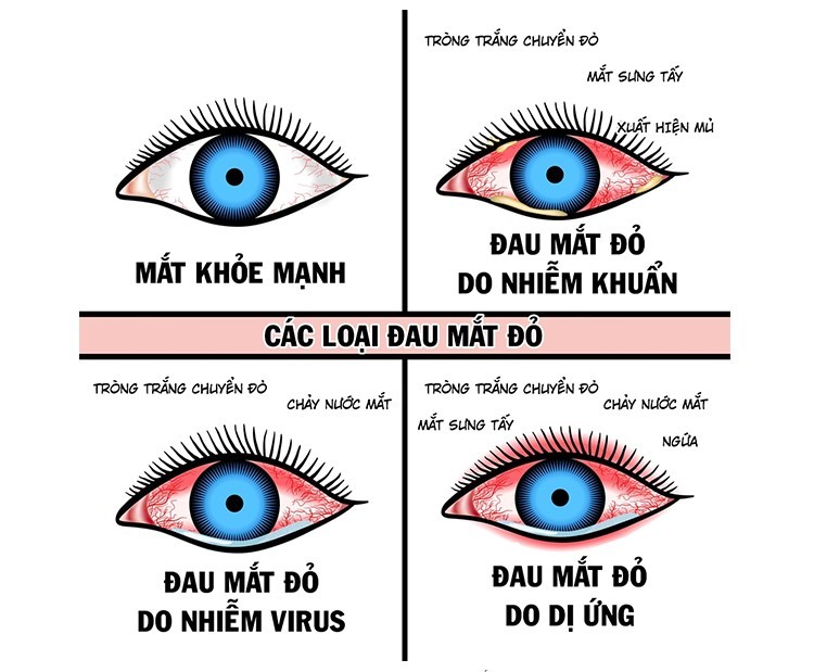Đau mắt đỏ lây qua đường gì thuốc nhỏ mắt tốt cho người cận thị, thuốc nhỏ mắt giảm cận thị, thuốc nhỏ mắt trị cận thị của nhật, mắt cận nên dùng thuốc nhỏ mắt nào, thuốc nhỏ mắt nào tốt cho mắt cận, bị cận thị nên dùng thuốc nhỏ mắt nào, cận thị có nên dùng thuốc nhỏ mắt rohto, thuốc nhỏ mắt nào tốt cho người cận thị, thuốc nhỏ mắt cho mắt cận thị, cận thị có nên dùng thuốc nhỏ mắt, người bị cận nên dùng thuốc nhỏ mắt nào, thuốc nhỏ mắt dùng cho người cận thị