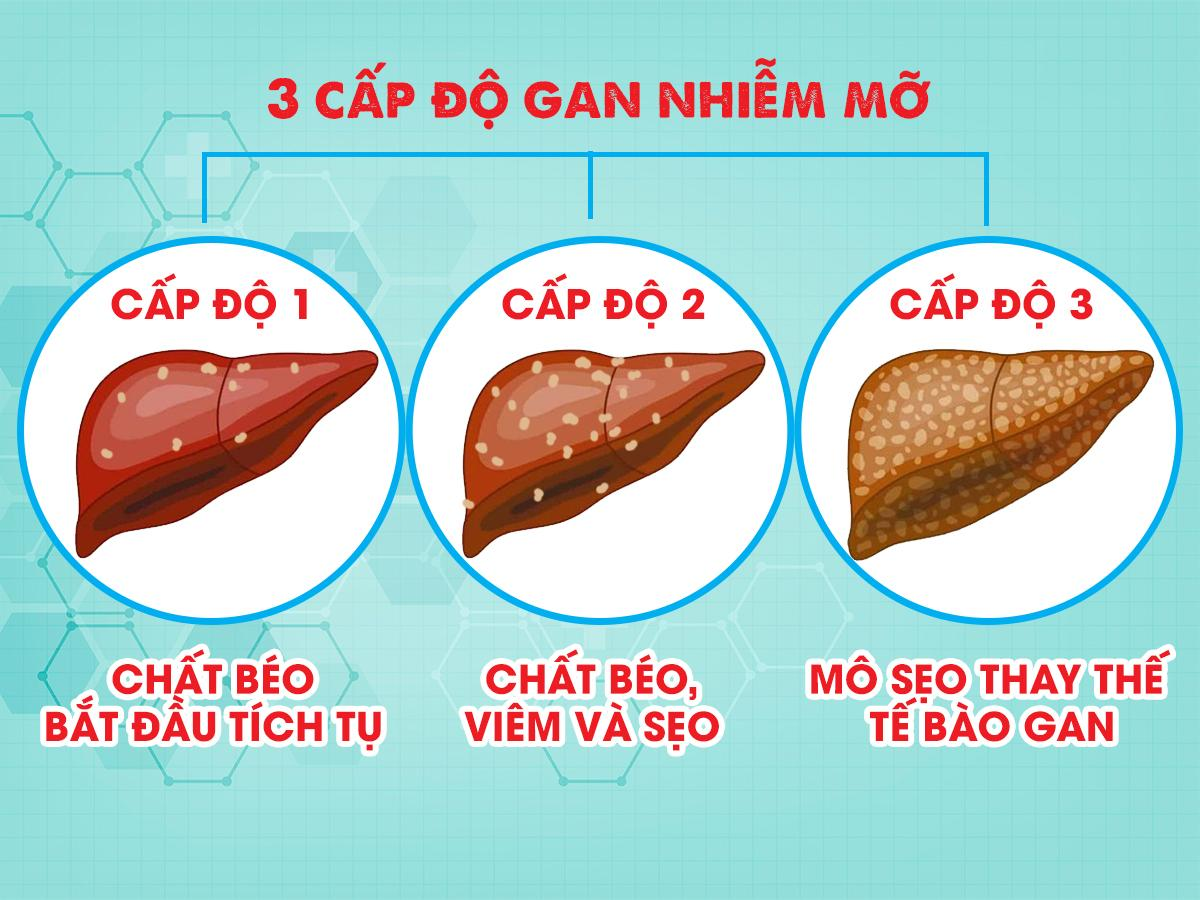 gan nhiễm mỡ uống thuốc gì, gan nhiễm mỡ cấp độ 2, gan nhiễm mỡ độ 2 uống thuốc gì, gan nhiễm mỡ độ 1 uống thuốc gì, gan nhiễm mỡ có mấy độ, gan nhiễm mỡ cấp độ 3, siêu âm gan nhiễm mỡ, gan nhiễm mỡ không nên ăn gì, gan nhiễm mỡ ăn kiêng gì