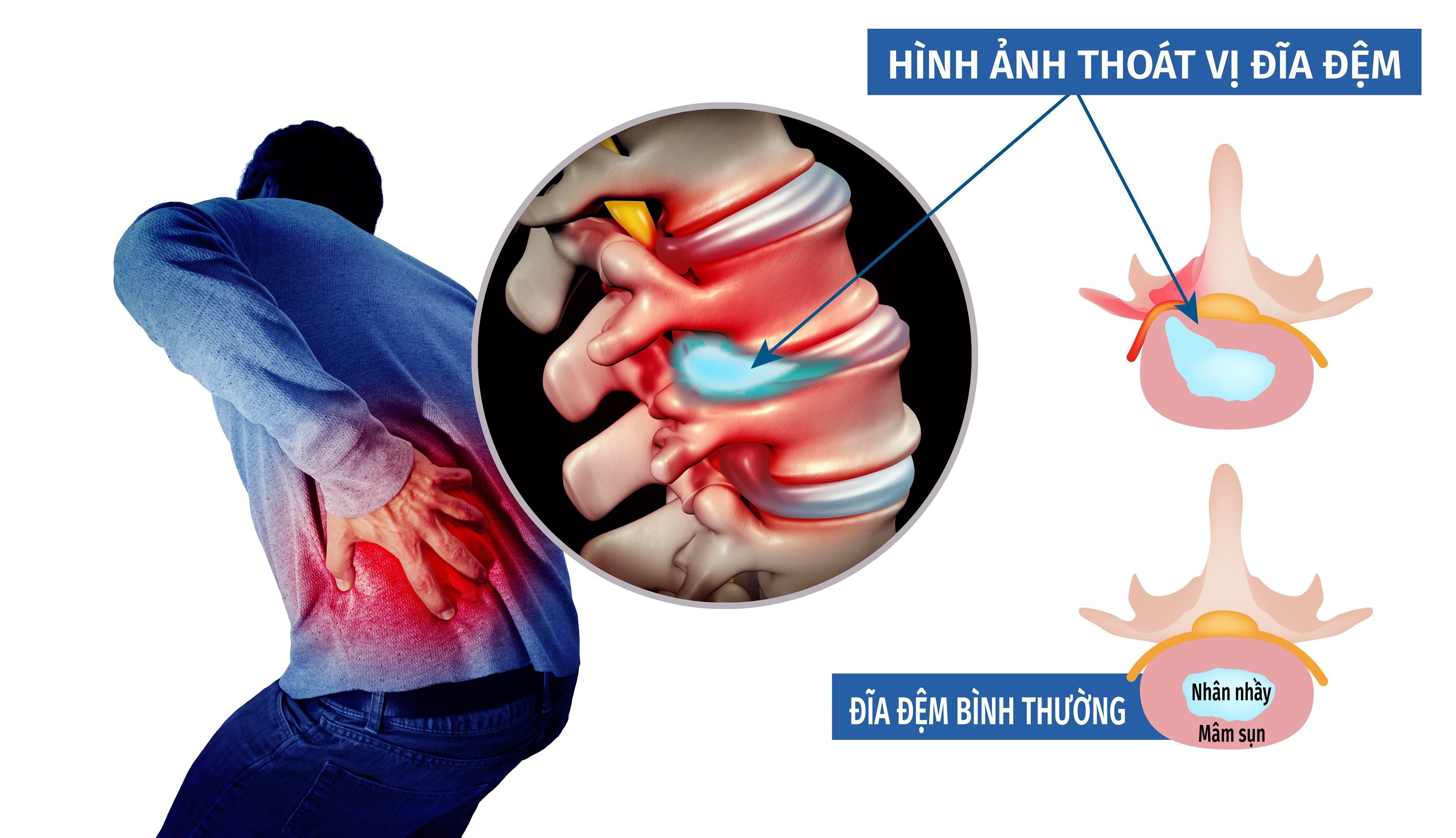Bị thoát vị đĩa đệm nên tập gì bị thoát vị đĩa đệm nên tập gì, người bị thoát vị đĩa đệm nên tập gì, thoát vị đĩa đệm có nên tập thể dục, thoát vị đĩa đệm tập thể dục, thoát vị đĩa đệm có tập được yoga, thoát vị đĩa đệm có nên tập aerobic, thoát vị đĩa đệm có nên tập thể hình, thoát vị đĩa đệm cổ nên tập gì, tập gì khi bị thoát vị đĩa đệm, tập luyện thoát vị đĩa đệm