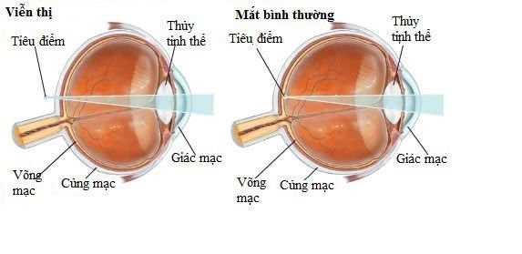 cận loạn thị là gì, độ cận thị là gì, tật cận thị là gì, đo cận thị ở đâu, cận thị là gì viễn thị là gì, nguyên nhân gây cận thị là gì, nhất cận thị nhị cận giang là gì, cận thị thoái hóa là gì, mắt cận thị là gì