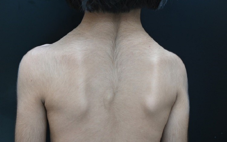 Bệnh Cantú là bệnh gì? Bệnh Cantú là bệnh gì