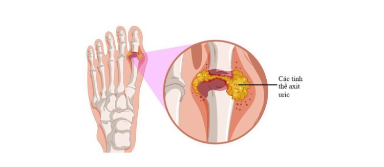 Bệnh gút có ăn được thịt gà không bệnh gút có an được thịt gà không, bị gút có ăn được thịt gà không, gút có ăn được thịt gà không, bệnh gout có ăn được thịt gà không, bị bệnh gút có ăn được thịt gà không, bệnh gout có ăn được thịt gà, bị gout có nên ăn thịt gà, bệnh gút ăn được thịt gà không