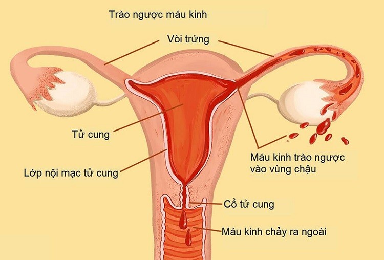 Bệnh lạc nội mạc tử cung có thể có con không, Bệnh lạc nội mạc tử cung
