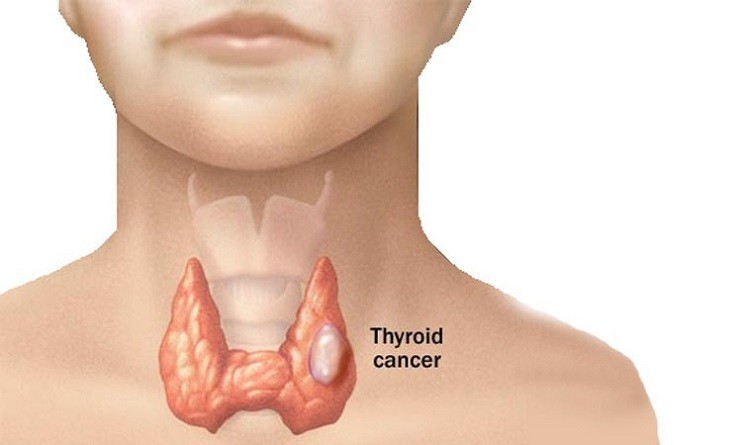 Bệnh cường giáp có chữa khỏi được không bệnh cường giáp điều trị bao lâu, bệnh cường giáp có chữa khỏi được không, bệnh cường tuyến giáp là gì, bệnh cường giáp có nguy hiểm, dấu hiệu của bệnh cường giáp, nguyên nhân bị cường giáp