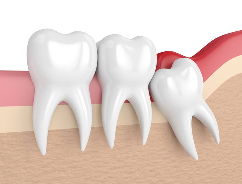 cách chữa viêm lợi trùm tại nhà, cách chữa viêm lợi trùm, cách điều trị viêm lợi trùm, chữa viêm lợi trùm, cách trị viêm lợi trùm