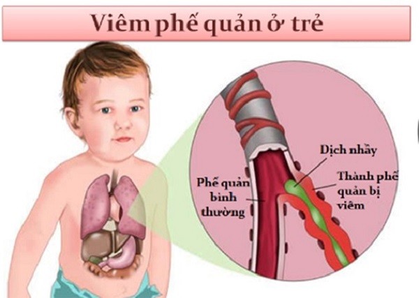 viêm phế quản ở trẻ em, viêm phế quản trẻ em, viêm phế quản phổi ở trẻ em, viêm phế quản cấp ở trẻ em, bệnh viêm phế quản ở trẻ em, phác đồ điều trị viêm phế quản ở trẻ em, viêm phế quản ở trẻ em bao lâu thì khỏi, triệu chứng viêm phế quản ở trẻ em, viêm phế quản ở trẻ nhỏ, thuốc điều trị viêm phế quản ở trẻ em, điều trị viêm phế quản phổi ở trẻ em, nguyên nhân viêm phế quản ở trẻ em