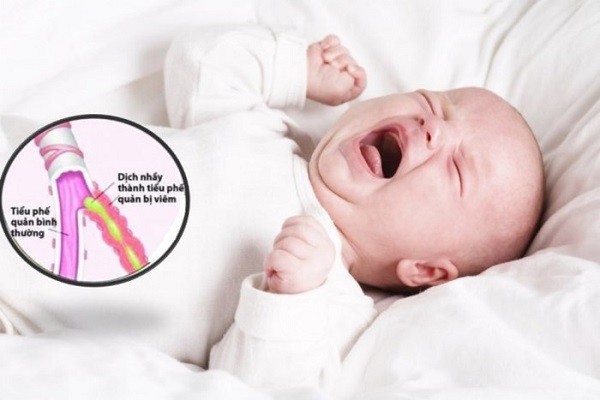 viêm phế quản ở trẻ em, viêm phế quản trẻ em, viêm phế quản phổi ở trẻ em, viêm phế quản cấp ở trẻ em, bệnh viêm phế quản ở trẻ em, phác đồ điều trị viêm phế quản ở trẻ em, viêm phế quản ở trẻ em bao lâu thì khỏi, triệu chứng viêm phế quản ở trẻ em, viêm phế quản ở trẻ nhỏ, thuốc điều trị viêm phế quản ở trẻ em, điều trị viêm phế quản phổi ở trẻ em, nguyên nhân viêm phế quản ở trẻ em